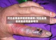 河北省易县炭疽疫情最新/河北省易县炭疽疫情最新情况