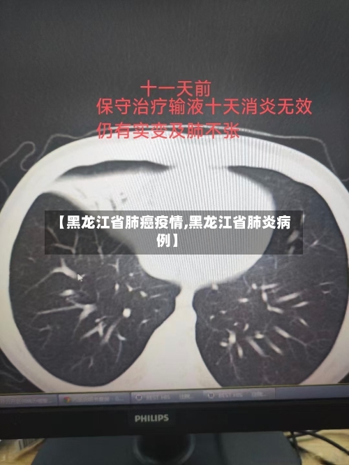 【黑龙江省肺癌疫情,黑龙江省肺炎病例】-第2张图片