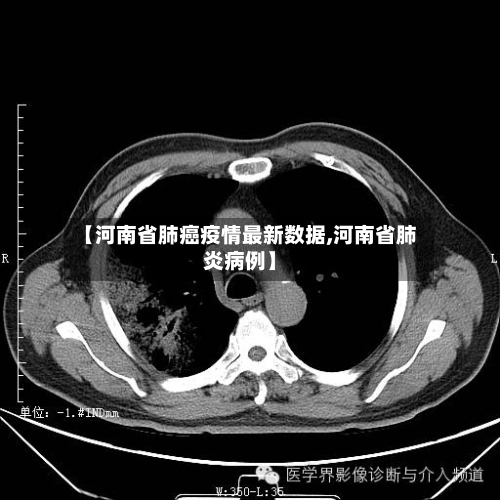 【河南省肺癌疫情最新数据,河南省肺炎病例】-第2张图片