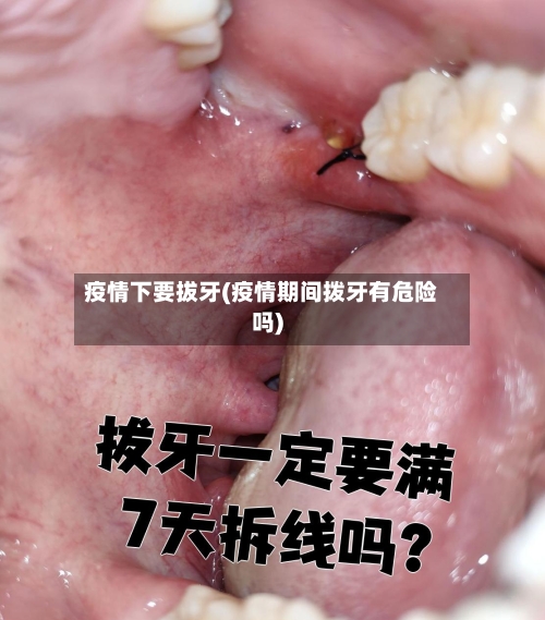 疫情下要拔牙(疫情期间拨牙有危险吗)-第2张图片