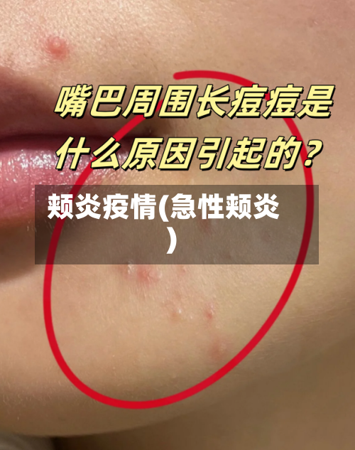 颊炎疫情(急性颊炎)-第1张图片