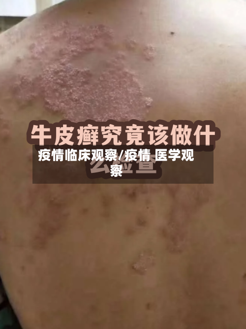 疫情临床观察/疫情 医学观察-第2张图片